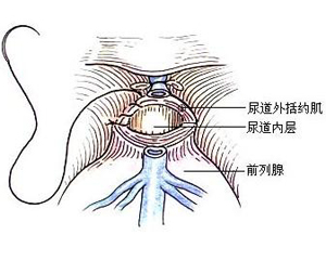 犬前列腺癌